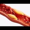 Salute: nuove linee guida dislipidemie, ‘abbassare e stabilizzare colesterolo’