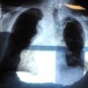 Bpco, pneumologa Foschino Barbaro: “Nella donna sintomi diversi, attenzione alle giovani”