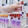 Dal microbiota una speranza contro l’epilessia resistente, lo studio italiano