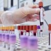 Tumore alla prostata, novità nelle terapie dei casi più gravi