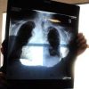 Cancro polmone, scoperta mutazione alleata dell’immunoterapia