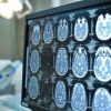 Telemedicina, progetto telestroke permette di trattare ictus a distanza