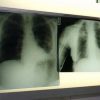 Cancro polmone a piccole cellule, ok Ue a tislelizumab