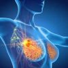 Tumore al seno triplo negativo, speranze da anticorpo farmaco-coniugato
