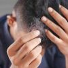 Il dermatologo: “Con alopecia areata disagi e costi alti, svecchiare linee guida”