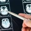 Intelligenza Artificiale può prevedere evoluzione Parkinson, lo studio italiano