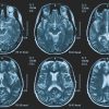 Tumori, glioma pediatrico di basso grado: via libera in Europa a prima terapia mirata