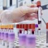 Tumori, cancro vescica: 70% pazienti libero da malattia a 2 anni con terapie perioperatorie