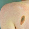 Melanoma, Adoi: “Bene nuova legge su prevenzione, dermatologo centrale in screening”