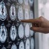 Salute, 300mila persone in Italia con Parkinson, 10% ha diagnosi prima dei 50 anni
