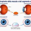 Torna a vedere dopo trapianto di retina da un occhio all’altro, è la prima volta al mondo