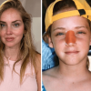 Chiara Ferragni, l’intervento al naso: “Ecco perché è storto ora”