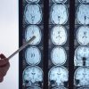 Di Battista e il tumore al cervello, in Italia circa 6mila diagnosi ogni anno: quali sono i sintomi ‘spia’