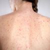 Morbillo, è allarme negli Usa. Italia prima per casi in Europa in in primi 6 mesi 2026