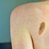 Melanoma, la firma mutazionale del cancro potrà cambiare la cura﻿